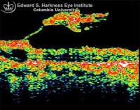 OCT study of a macular pucker demonstrating an elevated fovea off the pigment epithelium and a dense epiretinal membrane.